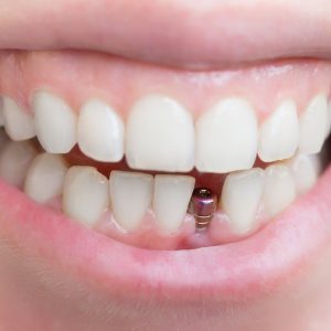 How Modern Dental Implants Restore Your Ability to Enjoy Crunchy and Chewy Foods Again